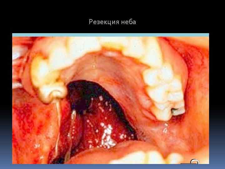Резекция неба 