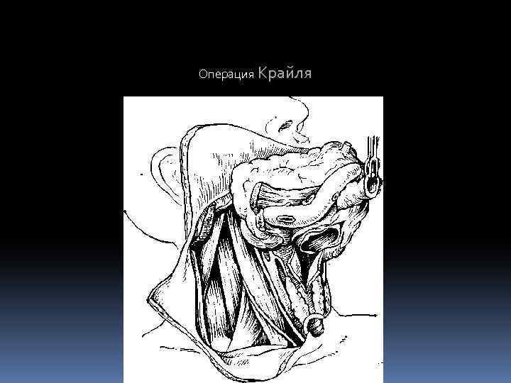 Операция Крайля 