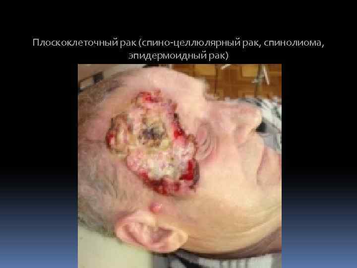 Плоскоклеточный рак (спино-целлюлярный рак, спинолиома, эпидермоидный рак) 