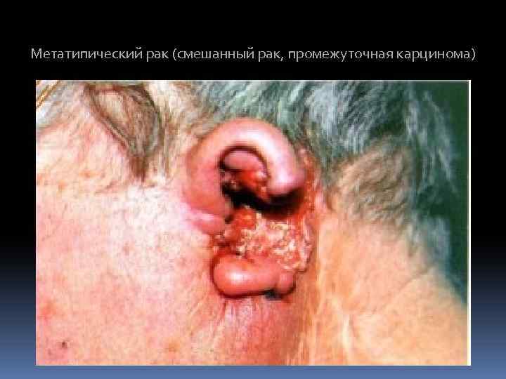 Метатипический рак (смешанный рак, промежуточная карцинома) 