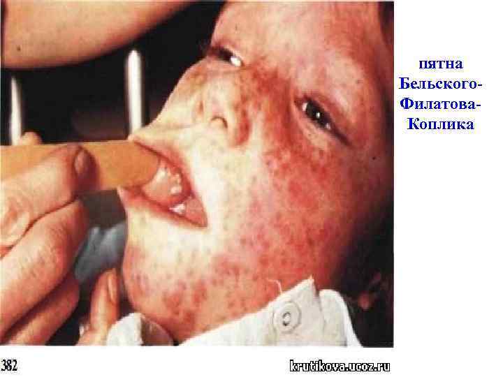 пятна Бельского. Филатова. Коплика 