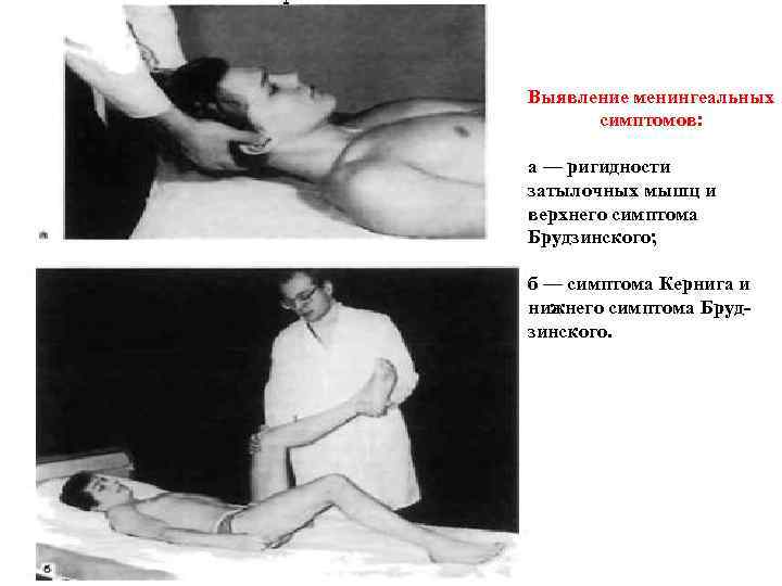 Выявление менингеальных симптомов: а — ригидности затылочных мышц и верхнего симптома Брудзинского; б —