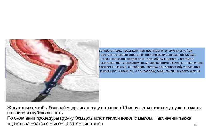 Кружку Эсмарха подвешивают на 1 метр над больным, открывают кран, и вода под давлением