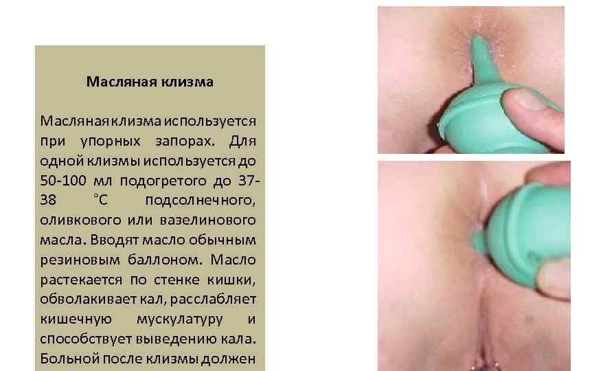 Масляная клизма используется при упорных запорах. Для одной клизмы используется до 50 -100 мл