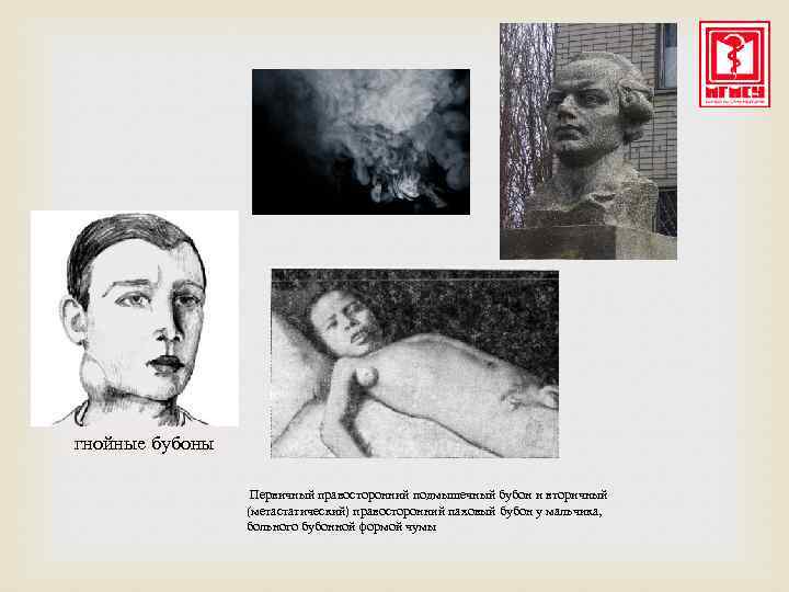 гнойные бубоны Первичный правосторонний подмышечный бубон и вторичный (метастатический) правосторонний паховый бубон у мальчика,