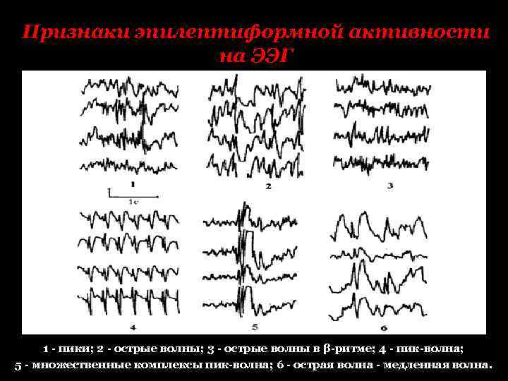 Медленные волны на ээг. Комплексы пик волна на ЭЭГ. Эпиактивность на ЭЭГ. ЭЭГ при эпилепсии пик волна. Комплекс острая волна медленная волна на ЭЭГ.