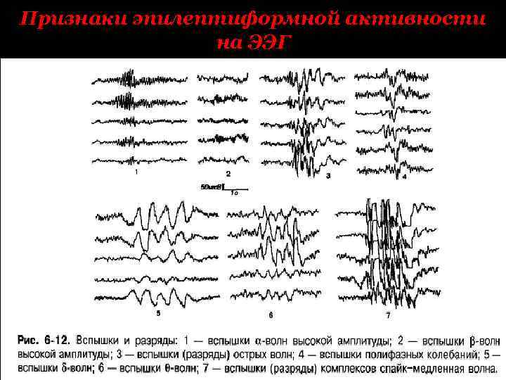 Ээг показывает эпилепсию. Эпилептиформные паттерны на ЭЭГ. ЭЭГ при эпилептическом припадке. ЭЭГ больного эпилепсией. Патологические ритмы ЭЭГ при эпилепсии.