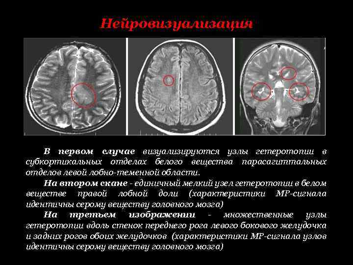 Единичный перивентрикулярный очаг. Субкортикальные отделы. Гетеротопия серого вещества. Гетеротопия головного мозга мрт. Субкортикальная гетеротопия.