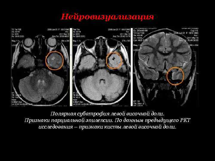 Нейровизуализация Полярная субатрофия левой височной доли. Признаки парциальной эпилепсии. По данным предыдущего РКТ исследования