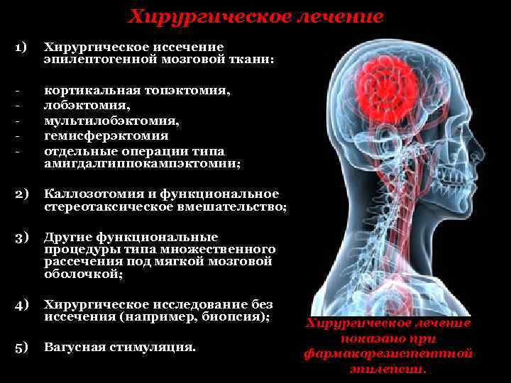 Хирургическое лечение 1) Хирургическое иссечение эпилептогенной мозговой ткани: - кортикальная топэктомия, лобэктомия, мультилобэктомия, гемисферэктомия