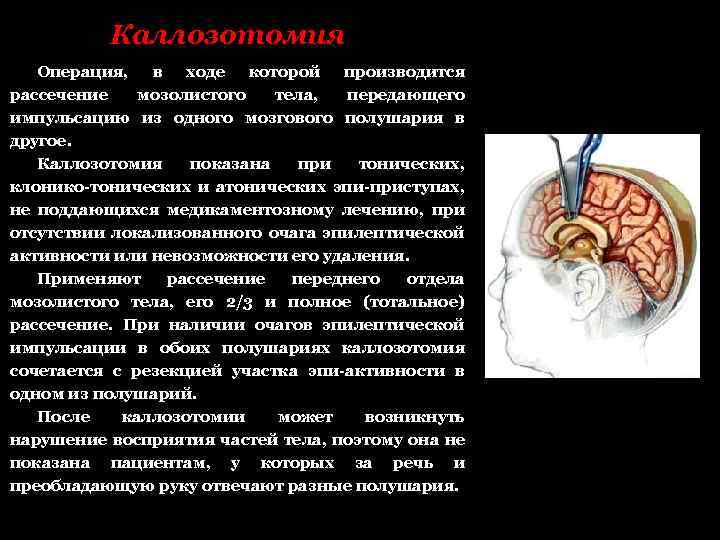 Каллозотомия Операция, в ходе которой производится рассечение мозолистого тела, передающего импульсацию из одного мозгового