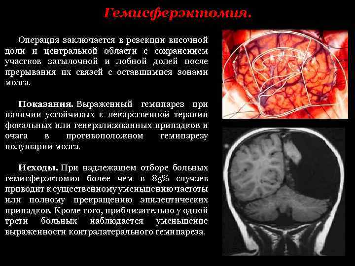 Гемисферэктомия. Операция заключается в резекции височной доли и центральной области с сохранением участков затылочной