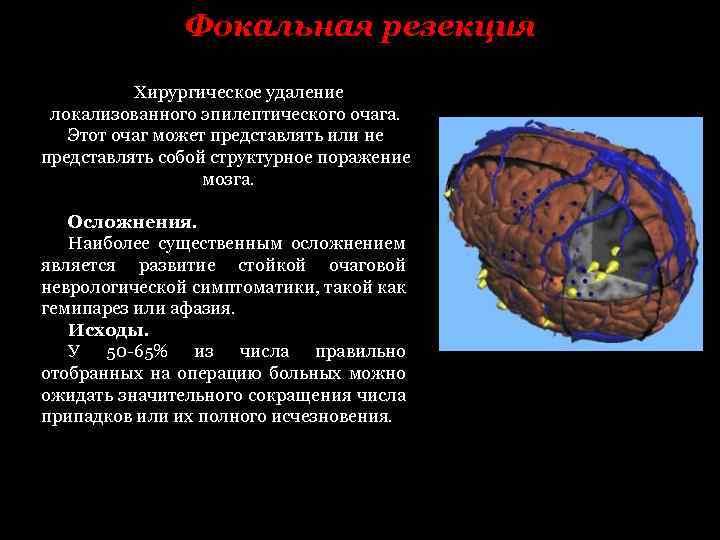 Эпилепсия патогенез презентация