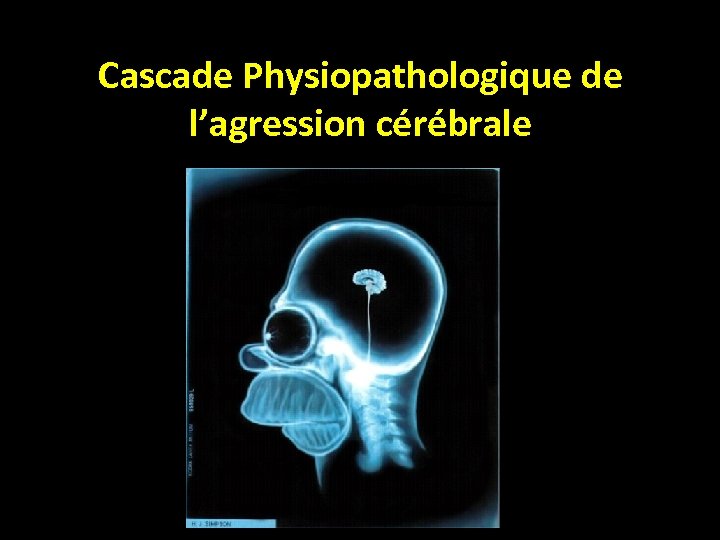 Cascade Physiopathologique de l’agression cérébrale 