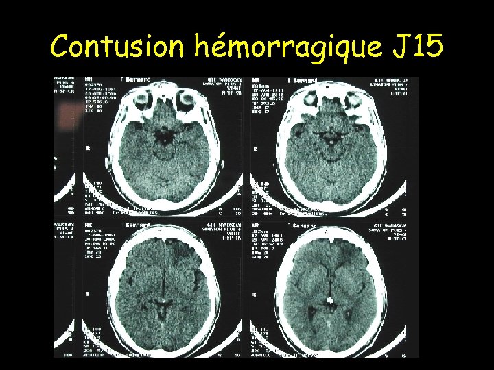 Contusion hémorragique J 15 
