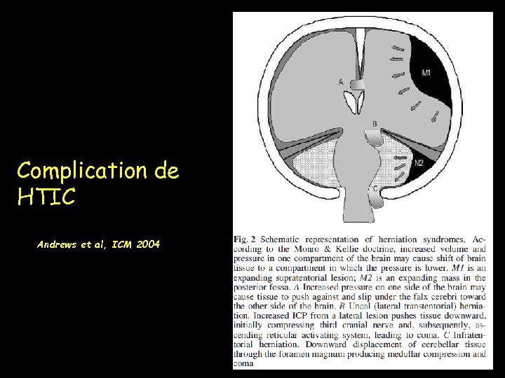 Complication de HTIC Andrews et al, ICM 2004 