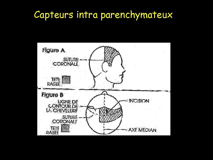 Capteurs intra parenchymateux 