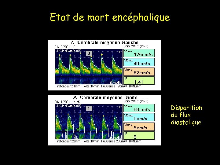 Etat de mort encéphalique Disparition du flux diastolique 