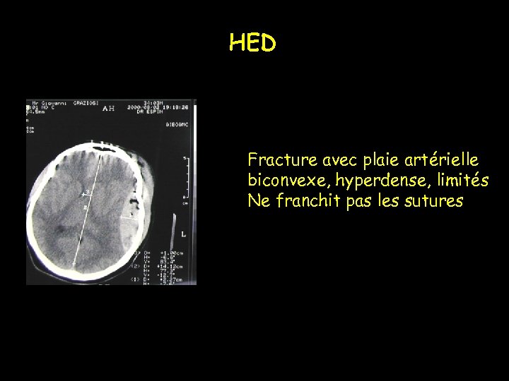 HED Fracture avec plaie artérielle biconvexe, hyperdense, limités Ne franchit pas les sutures 