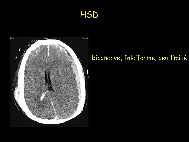 HSD biconcave, falciforme, peu limité 