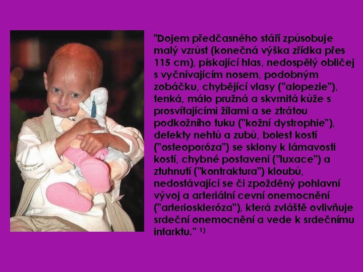 "Dojem předčasného stáří způsobuje malý vzrůst (konečná výška zřídka přes 115 cm), pískající hlas,