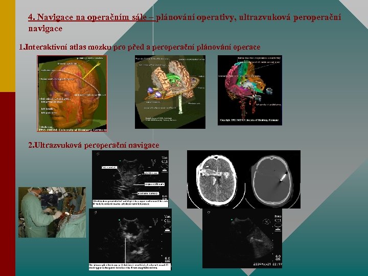 4. Navigace na operačním sále – plánování operativy, ultrazvuková peroperační navigace 1. Interaktivní atlas