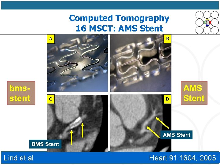 Computed Tomography 16 MSCT: AMS Stent A bmsstent C B D AMS Stent BMS