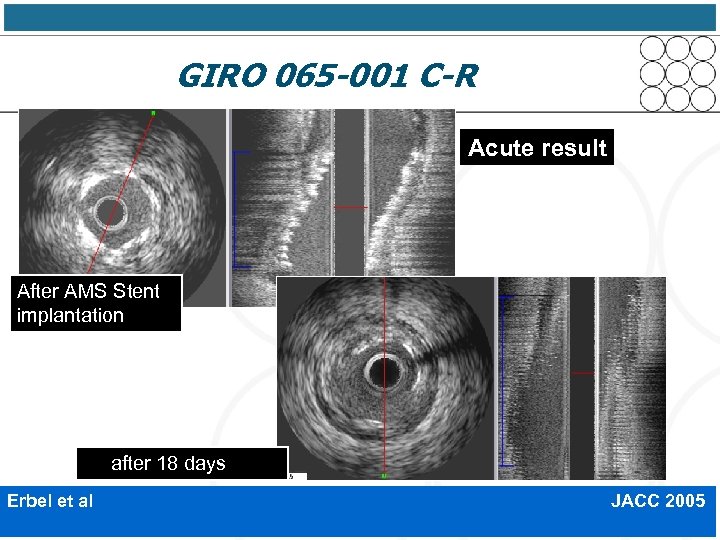  GIRO 065 -001 C-R Acute result After AMS Stent implantation after 18 days