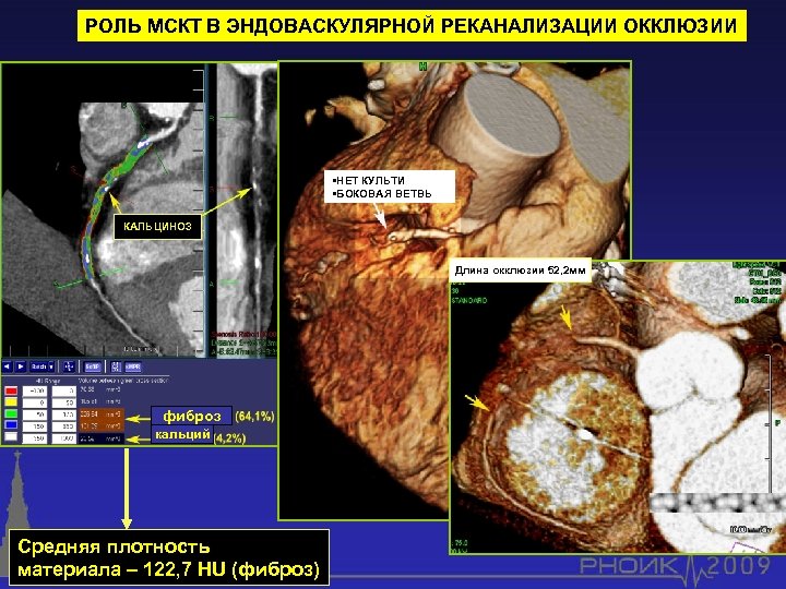 РОЛЬ МСКТ В ЭНДОВАСКУЛЯРНОЙ РЕКАНАЛИЗАЦИИ ОККЛЮЗИИ • НЕТ КУЛЬТИ • БОКОВАЯ ВЕТВЬ КАЛЬЦИНОЗ Длина