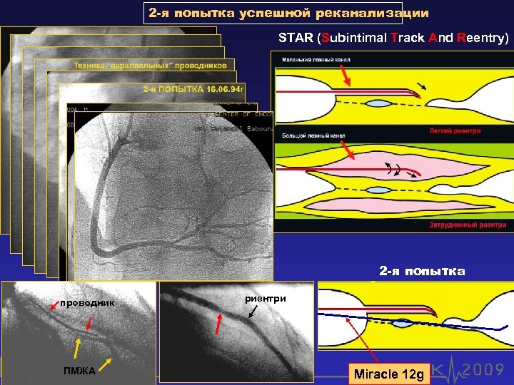 2 -я попытка успешной реканализации STAR (Subintimal Track And Reentry) 2 -я попытка проводник