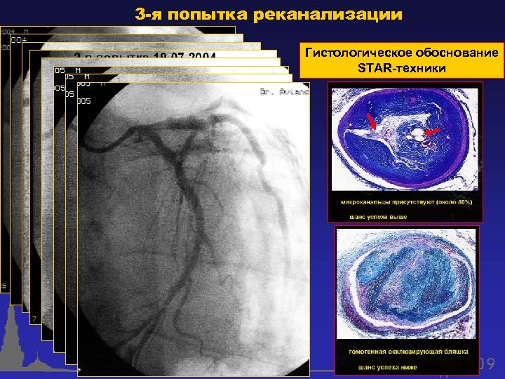 3 -я попытка реканализации Гистологическое обоснование STAR-техники 