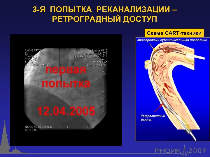 3 -Я ПОПЫТКА РЕКАНАЛИЗАЦИИ – РЕТРОГРАДНЫЙ ДОСТУП Схема CART-техники 