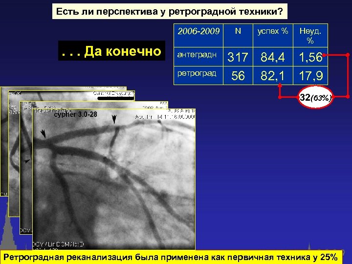 Есть ли перспектива у ретроградной техники? 2006 -2009 . . . Да конечно антеградн
