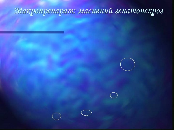 Макропрепарат: масивний гепатонекроз 