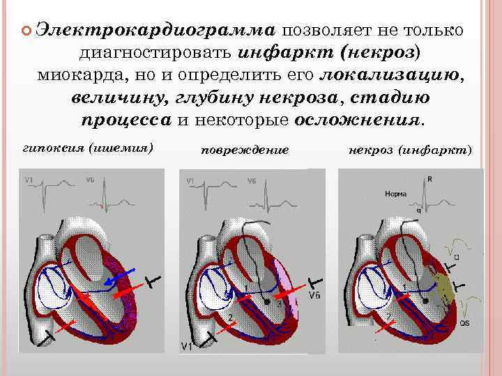  Электрокардиограмма позволяет не только диагностировать инфаркт (некроз) миокарда, но и определить его локализацию,