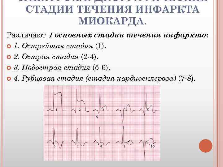 ЭЛЕКТРОКАРДИОГРАФИЧЕСКИЕ СТАДИИ ТЕЧЕНИЯ ИНФАРКТА МИОКАРДА. Различают 4 основных стадии течения инфаркта: 1. Острейшая стадия