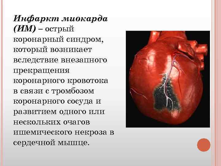 Инфаркт миокарда (ИМ) – острый коронарный синдром, который возникает вследствие внезапного прекращения коронарного кровотока