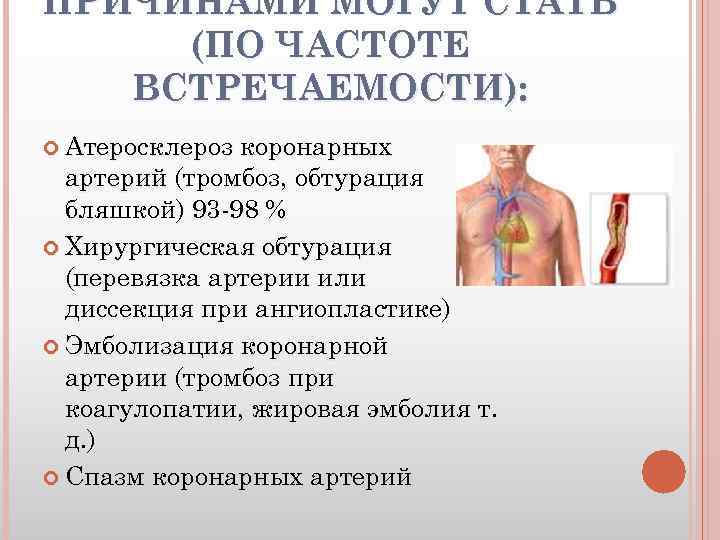 ПРИЧИНАМИ МОГУТ СТАТЬ (ПО ЧАСТОТЕ ВСТРЕЧАЕМОСТИ): Атеросклероз коронарных артерий (тромбоз, обтурация бляшкой) 93 -98