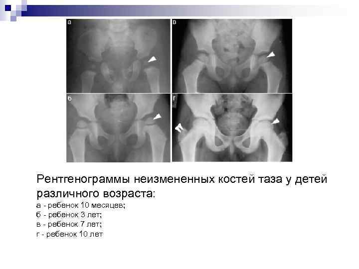Рентгенограммы неизмененных костей таза у детей различного возраста: а - ребенок 10 месяцев; б