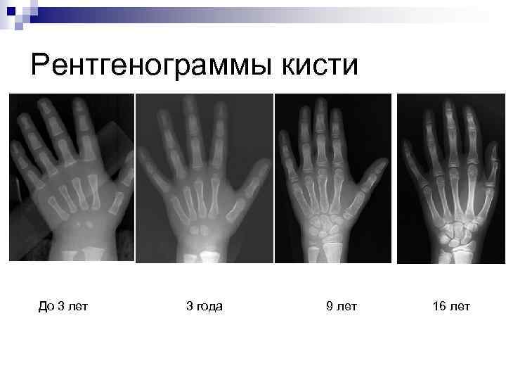 Рентгенограммы кисти До 3 лет 3 года 9 лет 16 лет 