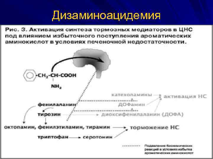 Дизаминоацидемия 