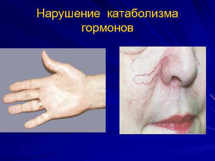 Нарушение катаболизма гормонов 