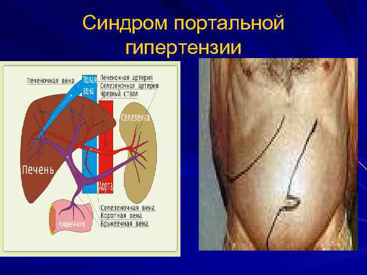 Синдром портальной гипертензии 
