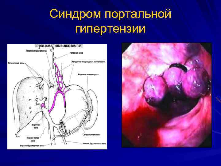 Синдром портальной гипертензии 
