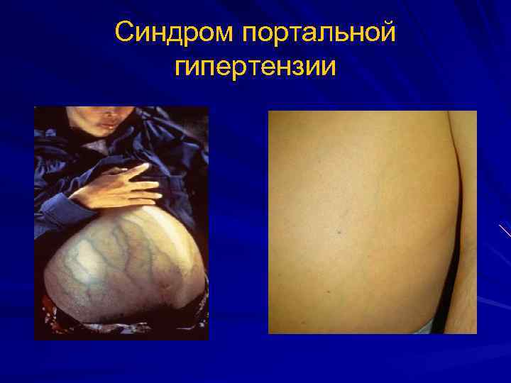 Синдром портальной гипертензии 
