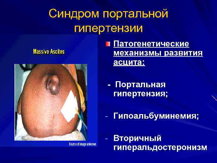 Синдром портальной гипертензии Патогенетические механизмы развития асцита: - Портальная гипертензия; - Гипоальбуминемия; - Вторичный