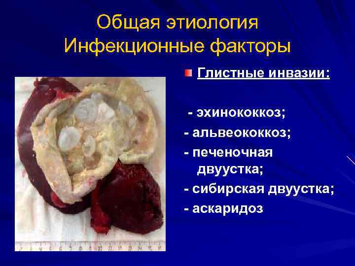 Общая этиология Инфекционные факторы Глистные инвазии: - эхинококкоз; - альвеококкоз; - печеночная двуустка; -