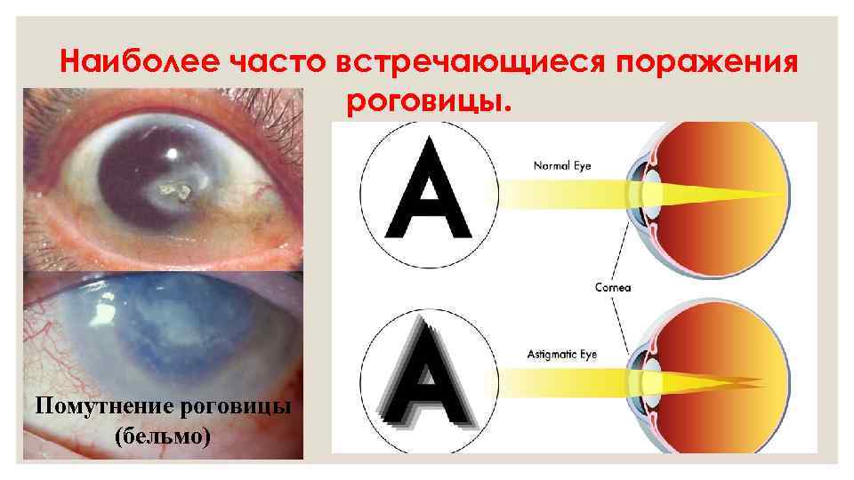Наиболее часто встречающиеся поражения роговицы. Помутнение роговицы (бельмо) 