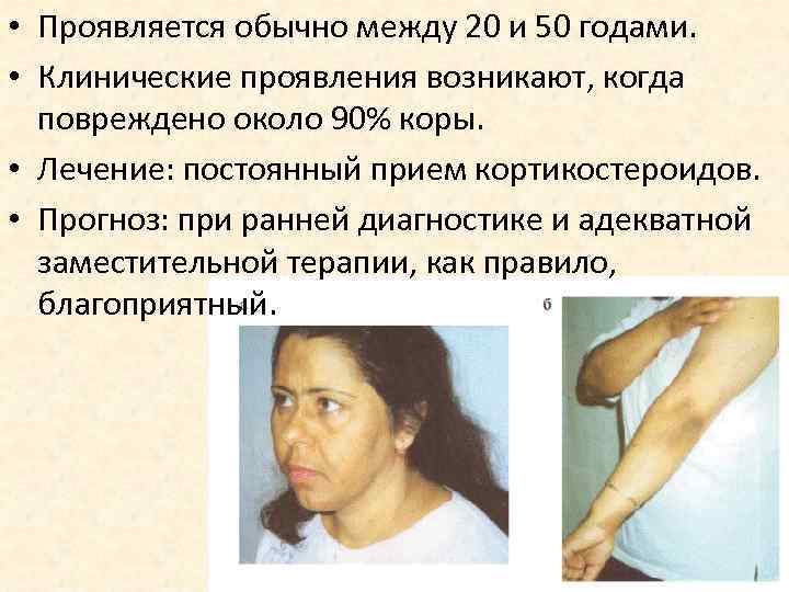  • Проявляется обычно между 20 и 50 годами. • Клинические проявления возникают, когда