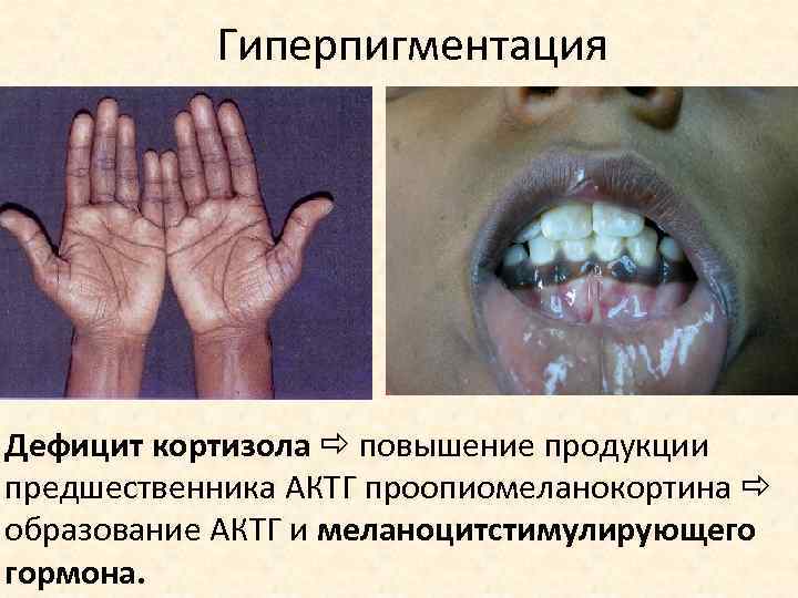 Гиперпигментация Дефицит кортизола повышение продукции предшественника АКТГ проопиомеланокортина образование АКТГ и меланоцитстимулирующего гормона. 